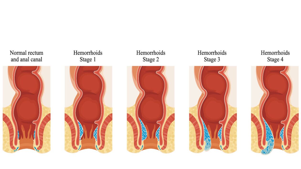 tipos de hemorróidas